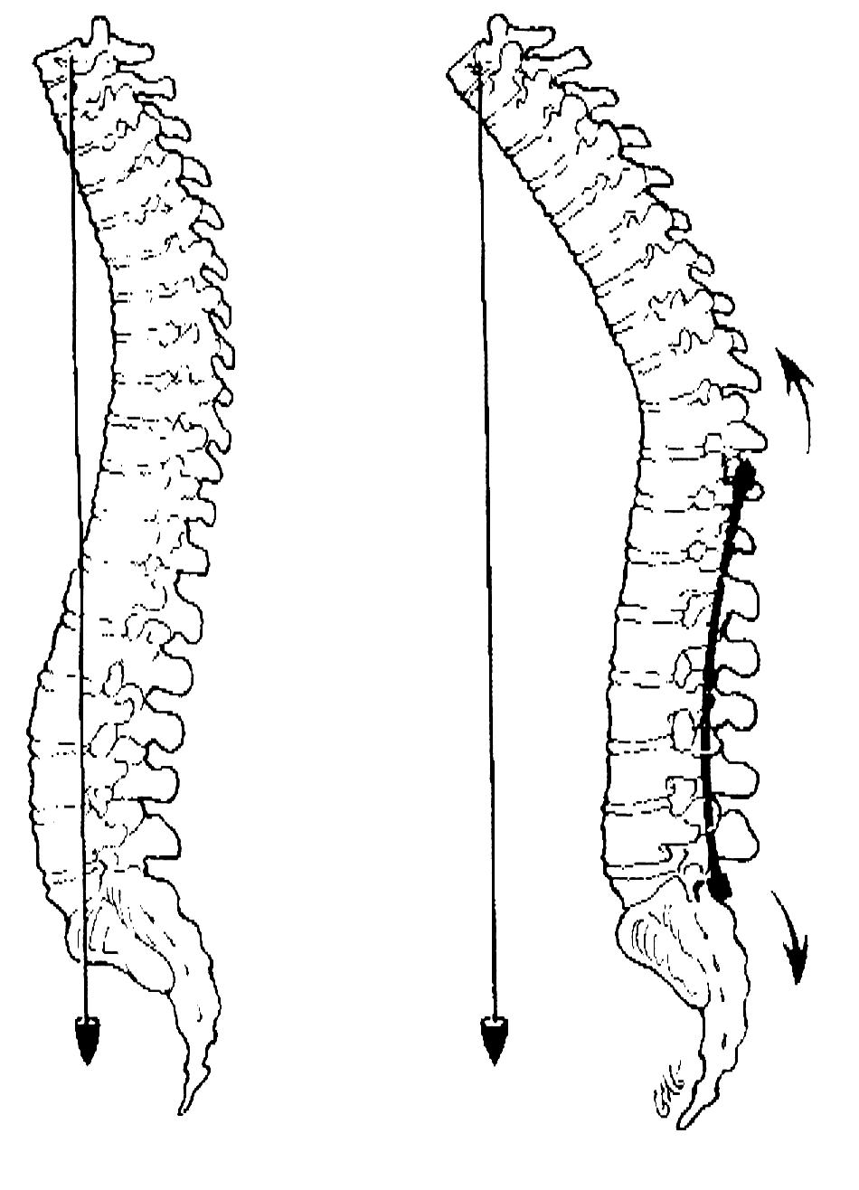 National Scoliosis Foundation